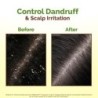 Mamaearth Lemon Anti-Dandruff Hair Oil for Flaky Scalp Scalp